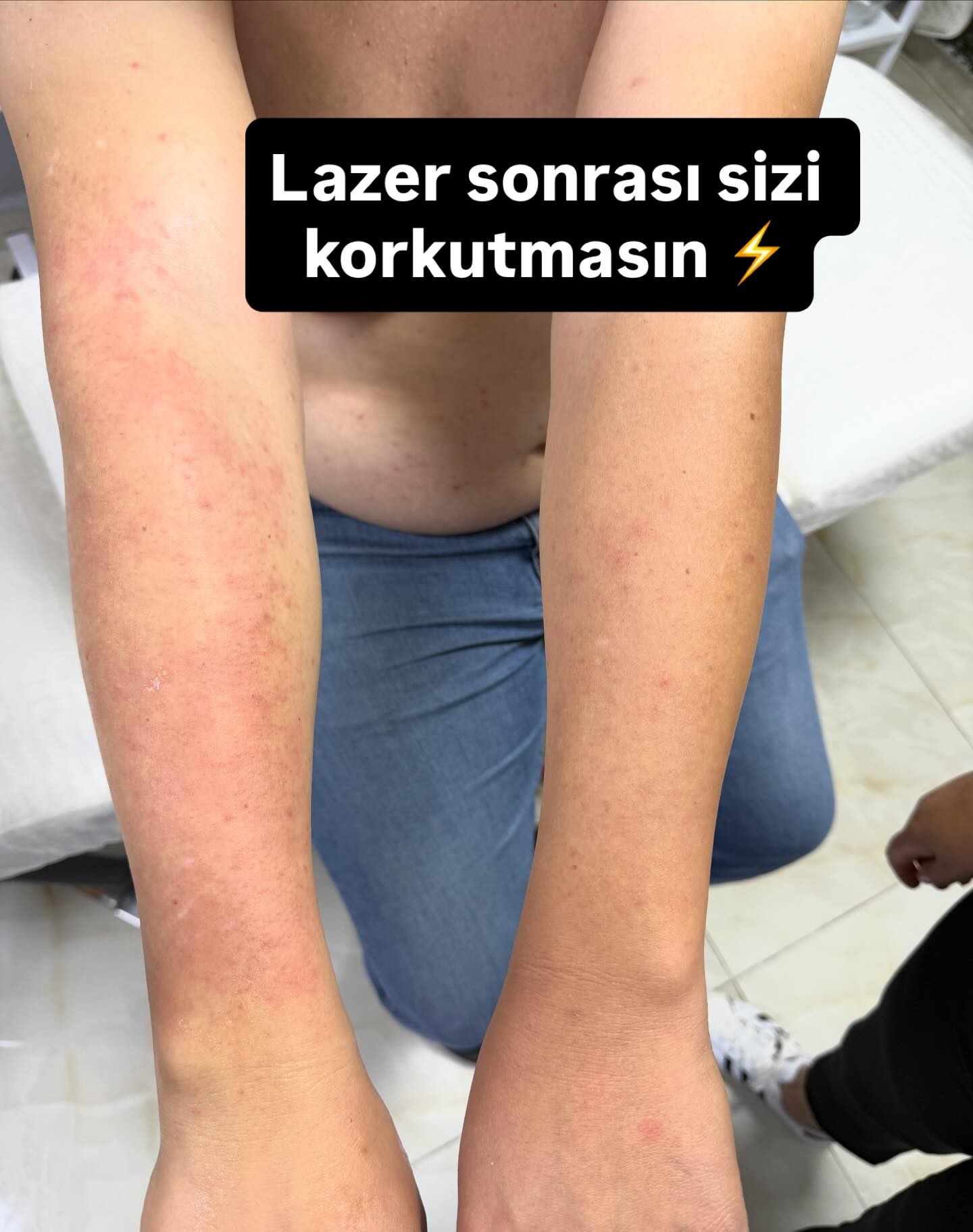 Lazer sonrası ciltte kızarıklık, hassasiyet ve minik kabarcıklar görmek sizi korkutmasın ⚡️

Bu görüntü, lazerin kıl köklerini hedef alırken cildin verdiği doğal bir tepkidir. Özellikle hassas ciltlerde veya yoğun kıl köklerinde bu reaksiyon biraz daha belirgin olabilir.

✨ Neden olur?• Kıl köklerinin ısı ile uyarılması• Cildin hassas yapısı• İşlem sonrası bakımın ihmal edilmesi

✨ Ne yapmalısınız?• İlk 24 saat sıcak su, sauna, hamam yok• Bölgeyi nemlendirmeyi ihmal etmeyin• Güneşten mutlaka koruyun ☀️• Kaşımayın, tahrişi artırmayın

Unutmayın: Bu durum genelde kısa sürede geçicidir ve doğru bakım ile hızla toparlanır 💫

Biz her zaman işlemin arkasındayız, cildiniz bize emanet 🤍Tuğçe Acar Beauty
#erkeklazeri #erkekagdasi #erkekişlemler #lazer #antalyakepezlazer